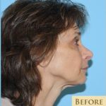Fat Grafting Before & After Patient #459