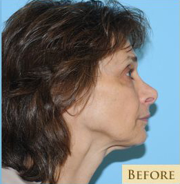 Fat Grafting Before & After Patient #459