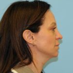 Fat Grafting Before & After Patient #466