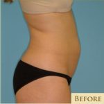 Liposuction Before & After Patient #473