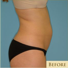 Liposuction Before & After Patient #473
