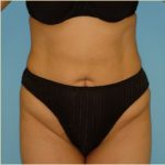 Abdominoplasty Before & After Patient #108