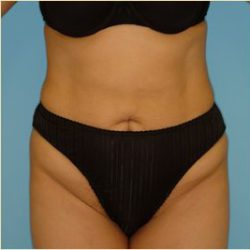 Abdominoplasty Before & After Patient #108