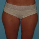 Liposuction Before & After Patient #487