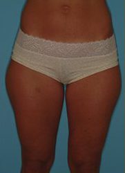Liposuction Before & After Patient #487