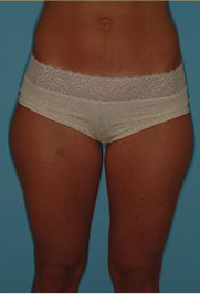 Liposuction Before & After Patient #487