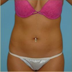 Liposuction Before & After Patient #492
