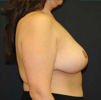 Explanation with Mastopexy Before & After Patient #527