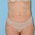 Abdominoplasty Before & After Patient #115