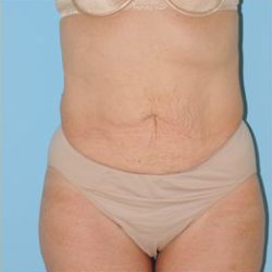 Abdominoplasty Before & After Patient #115