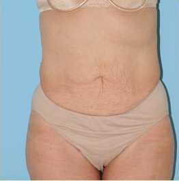 Abdominoplasty Before & After Patient #115