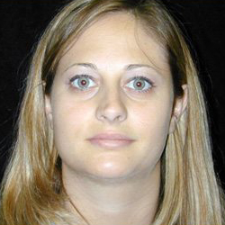 Rhinoplasty Before & After Patient #560