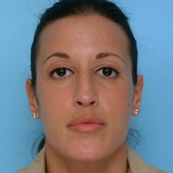 Rhinoplasty Before & After Patient #588