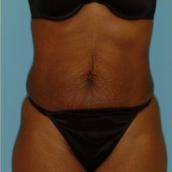Abdominoplasty Before & After Patient #122