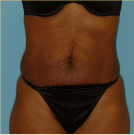 Abdominoplasty Before & After Patient #122