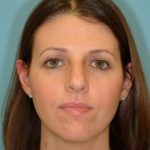 Rhinoplasty Before & After Patient #623