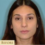 Rhinoplasty Before & After Patient #658