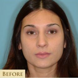 Rhinoplasty Before & After Patient #658