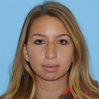 Rhinoplasty Before & After Patient #679