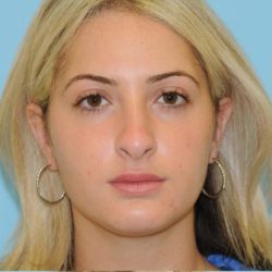 Rhinoplasty Before & After Patient #686