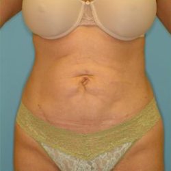 Abdominoplasty Before & After Patient #129