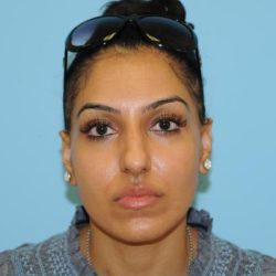 Rhinoplasty Before & After Patient #693