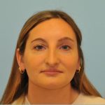 Rhinoplasty Before & After Patient #714