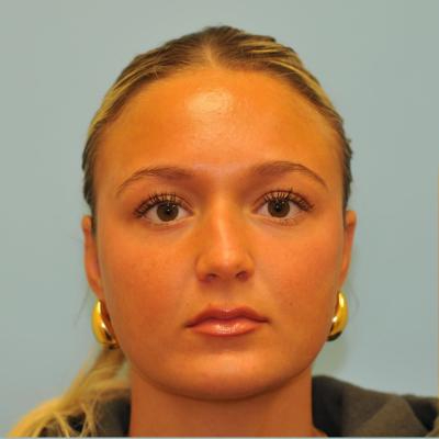 Rhinoplasty Before & After Patient #721