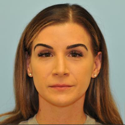 Rhinoplasty Before & After Patient #728