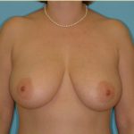 Mastopexy Before & After Patient #735