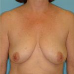 Mastopexy Before & After Patient #742