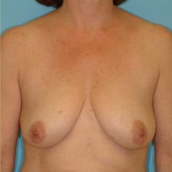 Mastopexy Before & After Patient #742