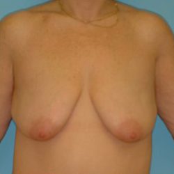 Mastopexy Before & After Patient #756