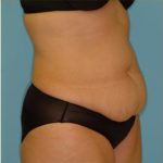 Abdominoplasty Before & After Patient #136