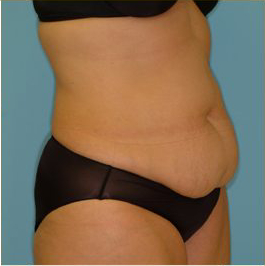 Abdominoplasty Before & After Patient #136