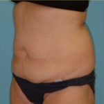 Abdominoplasty Before & After Patient #143
