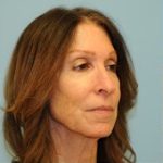 Facelift Before & After Patient #326