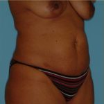 Abdominoplasty Before & After Patient #150