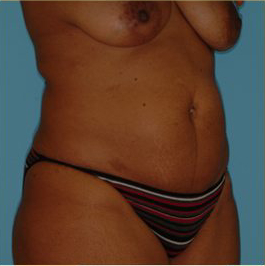 Abdominoplasty Before & After Patient #150