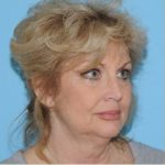 Facelift Before & After Patient #171