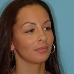 Blepharoplasty Before & After Patient #178