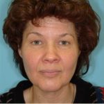 Blepharoplasty Before & After Patient #185