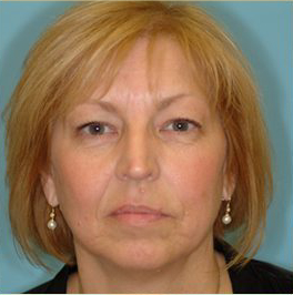 Blepharoplasty Before & After Patient #192