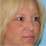 Blepharoplasty Before & After Patient #199