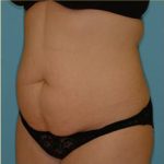 Abdominoplasty Before & After Patient #80