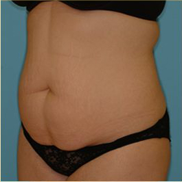 Abdominoplasty Before & After Patient #80