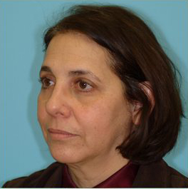 Facelift Before & After Patient #206