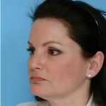 Blepharoplasty Before & After Patient #2770