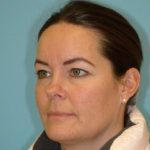 Blepharoplasty Before & After Patient #221