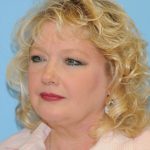 Facelift Before & After Patient #228